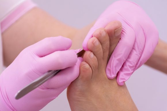 The hands of an unrecognizable female podiatrist with pink gloves cutting off the callus one foot with a scalpel